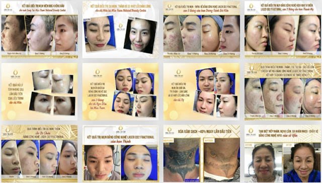 Miss Trâm Trị nám tàn nhang uy tín tại TPHCM 