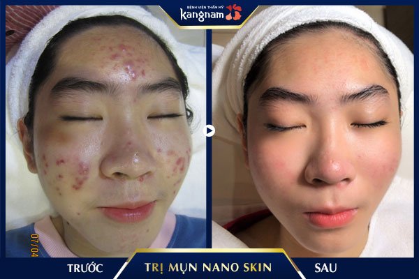 khách hàng trị mụn nano skin