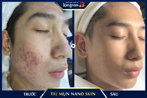 kết quả trị mụn nano skin
