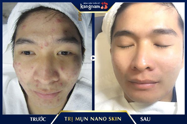 hình ảnh trị mụn nano skin