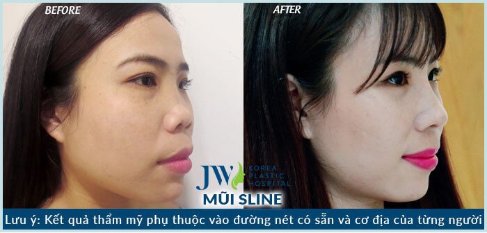Hình ảnh khách hàng sau khi nâng mũi s line