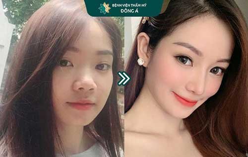 nâng mũi thẩm mỹ viện cần thơ