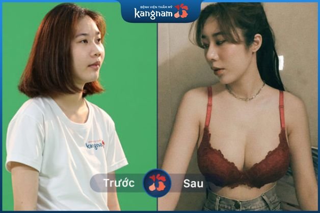 Cải thiện vòng 1 cuốn hút tự nhiên chỉ sau 1 lần nâng ngực tại Kangnam