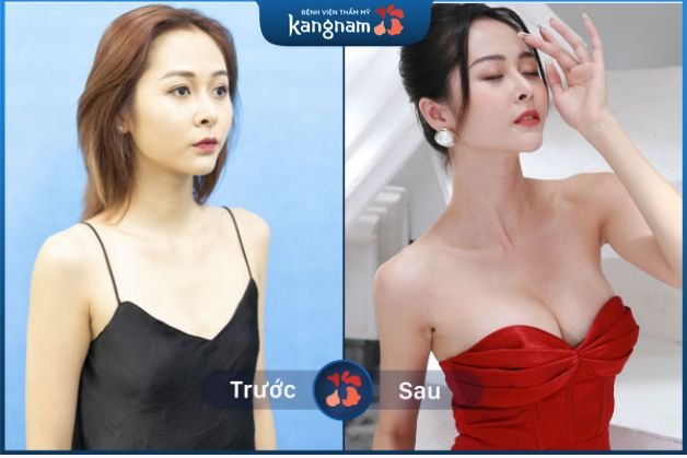 Tự tin xóa tan nỗi lo ngực lép, khoe dáng chuẩn đẹp như siêu mẫu sau khi nâng ngực 6D