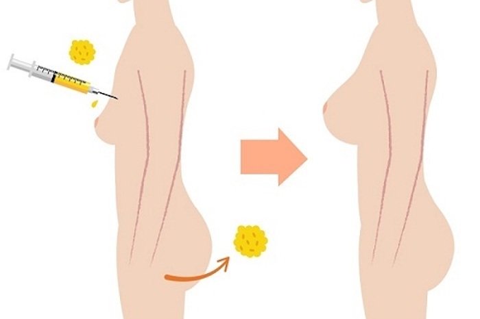 nâng ngực bằng mỡ tự thân