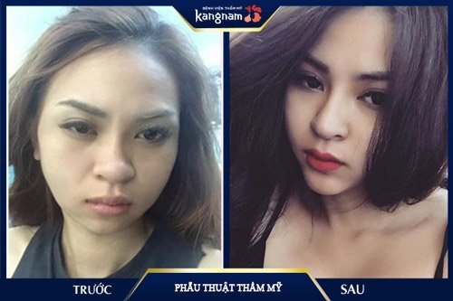 người mẫu kim anh phẫu thuật thẩm mỹ 
