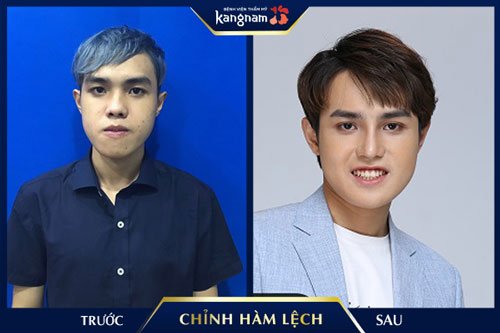 Trước: mặt bị lệch sang bên trái - Sau: xương hàm cân xứng, hai bên gương mặt hài hòa phẫu thuật chỉnh hàm lệch