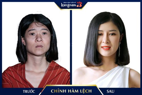 Trước: xương hàm bạnh, lệch vẹo - Sau: thu gọn góc hàm, mặt hài hòa, trẻ trung hơn phẫu thuật hàm lệch