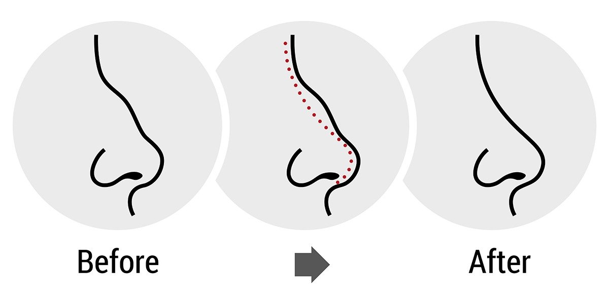 Thủ tục nâng mũi