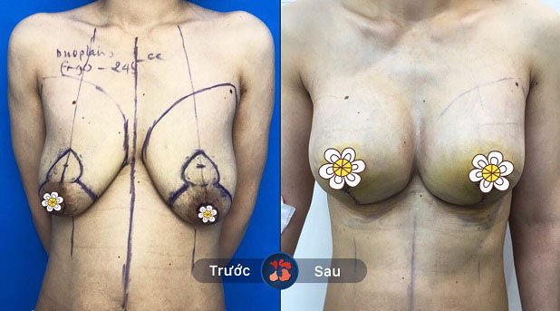 Thu gọn ngực tại Kangnam