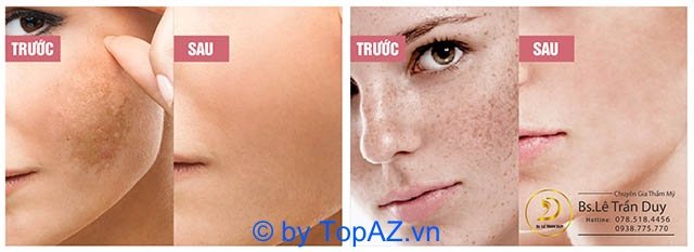 trị nám, tàn nhang ở đâu tốt nhất