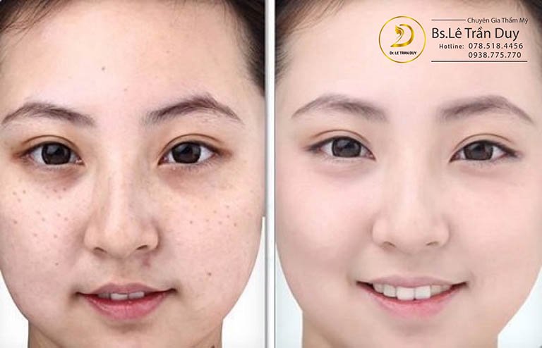 trị nám, tàn nhang ở đâu tốt nhất