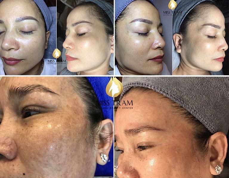 spa trị nám tàn nhang tphcm