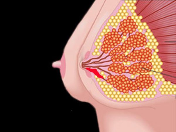 Nguyên nhân dẫn đến tình trạng tắc sữa nổi hạch 