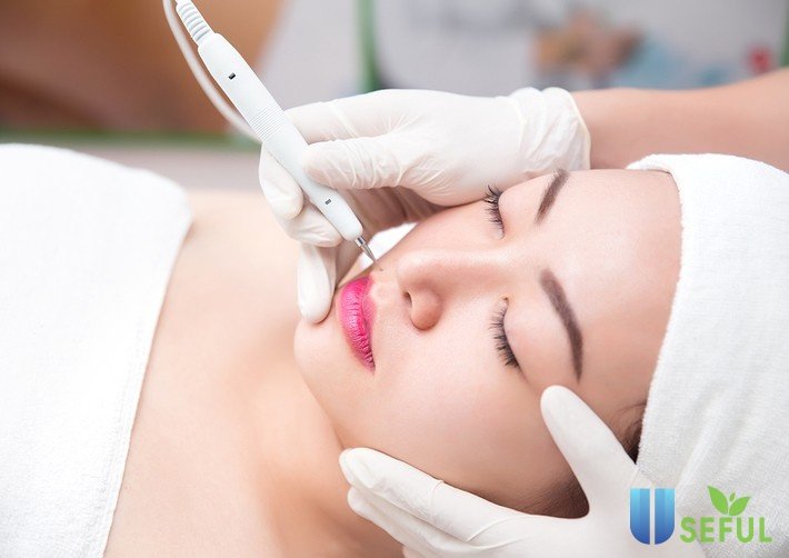 Tẩy nốt ruồi bằng tia laser có an toàn?