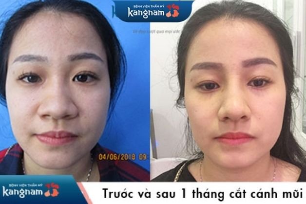 Khách hàng thu nhỏ cánh mũi hiệu quả tại Kangnam