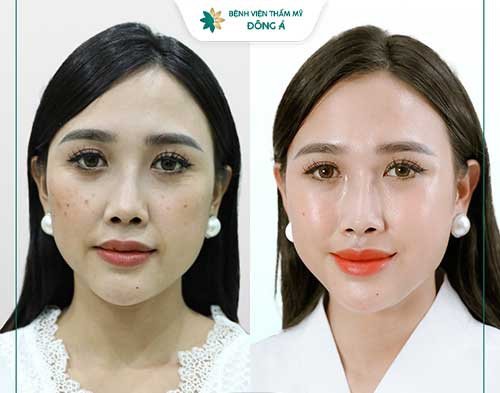 trẻ hóa da thẩm mỹ viện cần thơ