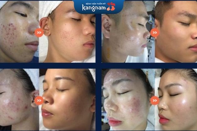 Da sạch mụn, hết thâm sau liệu trình từ 4 buổi
